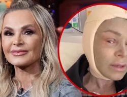 ‘RHOC’ Tamra Judge Documents Brow Lift, Face Peel Post-Op
