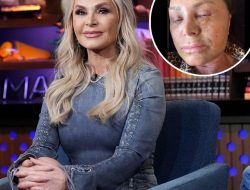 RHOC’s Tamra Judge Looks Unrecognizable After Cosmetic Procedure